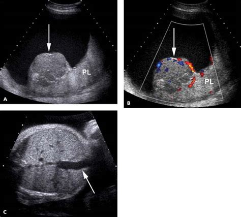 Placenta Radiology Key