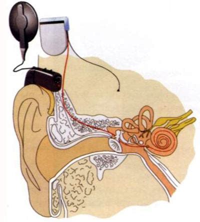 Impianto Cocleare Bioblog