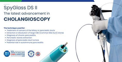 SpyGlass Cholangioscopy Prevents Major Surgeries In Bile Duct Large