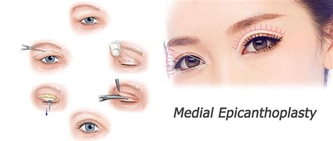 Medial Epicanthoplasty Nobel Medical Group