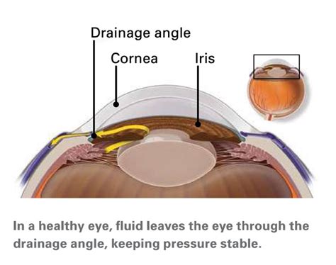 Glaucoma