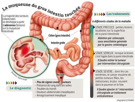 Cancer Colorectal Actualit S Sante Dz