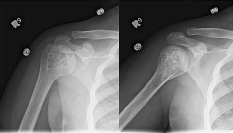 Right shoulder internal rotation and external rotation radiographs ...