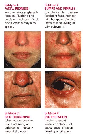 Rosacea Causes Treatments