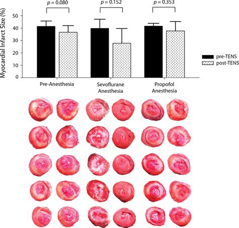 Comparisons Of Rat Myocardial Infarct Size Before And After Tens In