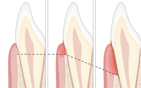 Parodontite Cause Conseguenze Diagnosi Terapia E Prevenzione