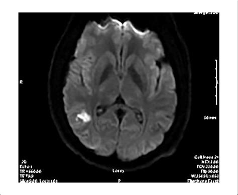 Magnetic Resonance Imaging Of The Brain Revealed An Ischemic Stroke Download Scientific Diagram