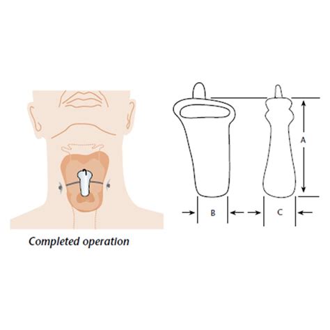 Laryngeal Stents Hood Laboratories