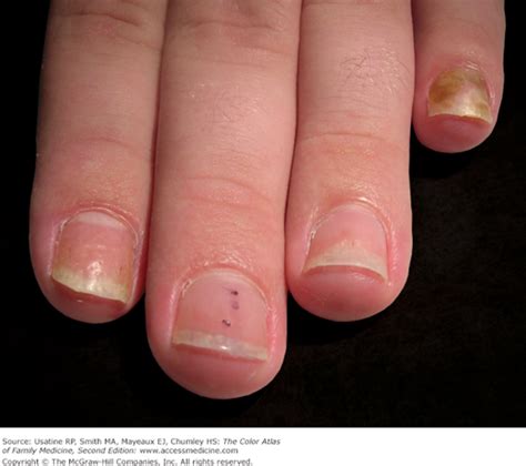 Psoriatic Nails | Basicmedical Key