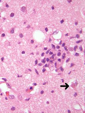 Pathology Outlines Herpes Simplex Encephalitis