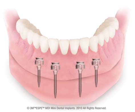 Dental Implant Options In Tampa Weninger Dentistry