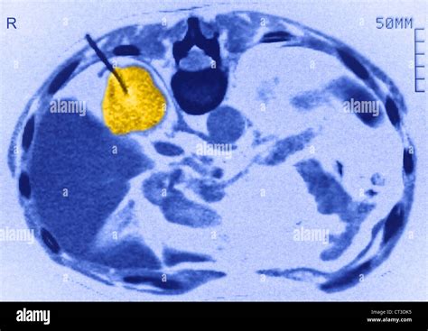 RENAL BIOPSY, SCAN Stock Photo - Alamy