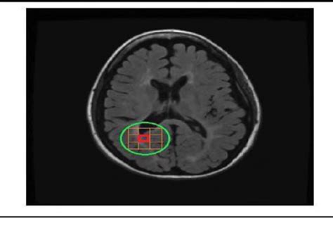 Figure 4 From Automatic Segmentation Of Multiple Sclerosis Lesions In Brain Mr Images Using