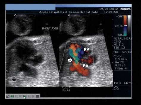 E An Axial Color Doppler Image Of The Right Ventricular Outflow Tract Download Scientific