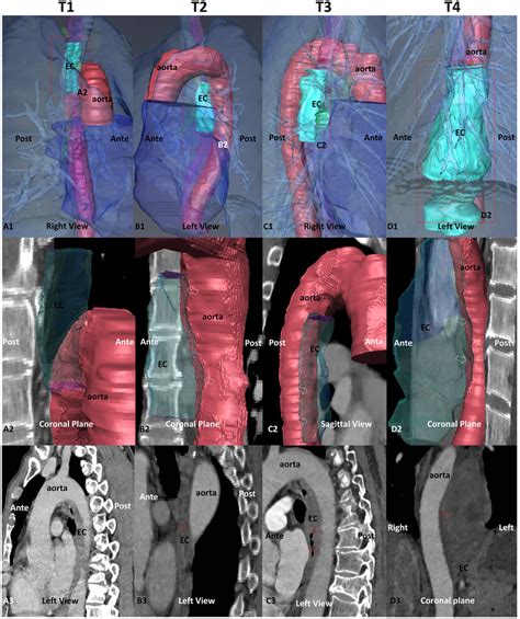 Relationship Between Tumour And Aorta In The 3D Reconstructed Model