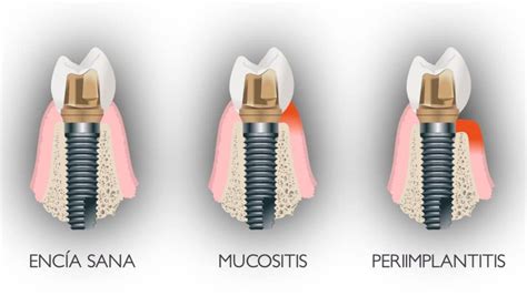 Qué Es Y Cómo Tratar La Periimplantitis Clínica Dental Seoane Pampín