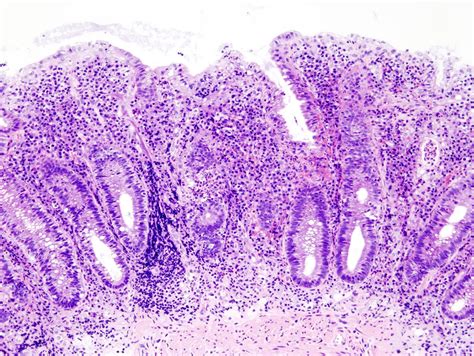 Ulcerative Colitis Colonoscopy Findings Shuttersay