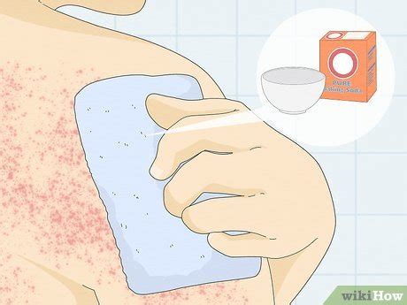 How to Treat Heat Rash: 14 Steps (with Pictures) - wikiHow