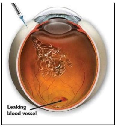 Intravitreal Anti Vegf Injection Speciliasts Sydney Retina