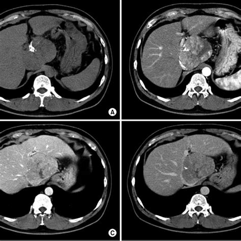 Computed Tomography Ct Findings Of The Liver Mass A At The Caudate