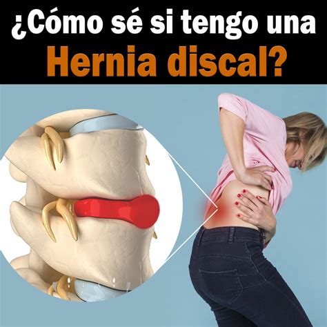 ¿cómo Saber Si Tu Dolor De Espalda Es Por Hernia Discal Cordus