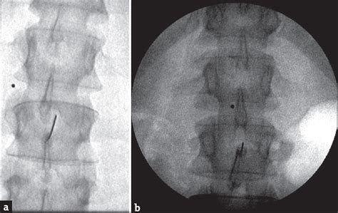 Radiation Reduction In Low Dose Pulsed Fluoroscopy Versus Standard Dose Continuous Fluoroscopy