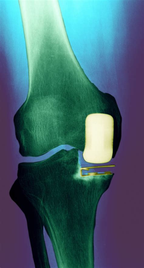 Partial Knee Replacement – Surgery For Part of the Joint