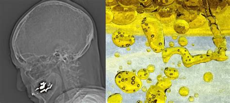 Oil Droplet Appearance Multiple Punched Out Lesions Regular In Download Scientific Diagram