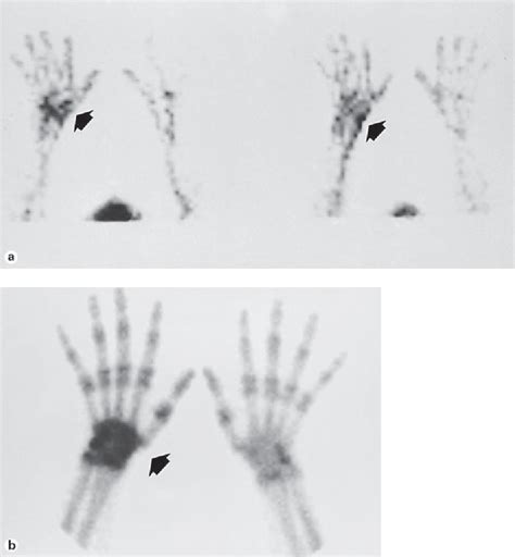 Impact Of Three Phase Bone Scintigraphy On The Diagnosis And Treatment