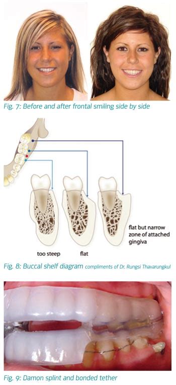 Case Presentation Non Surgical Correction Of Class Iii By Dr John Pobanz Orthotown