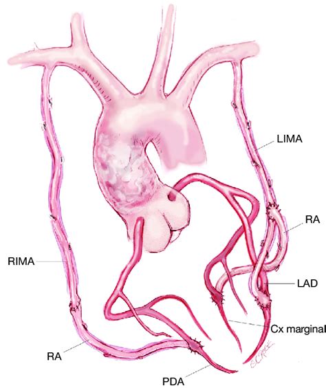 Illustration of bilateral internal mammary artery grafts. RIMA, right ...