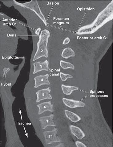 Image Result For Ct C Spine Diagram Cervical Vertebrae Spinal Canal