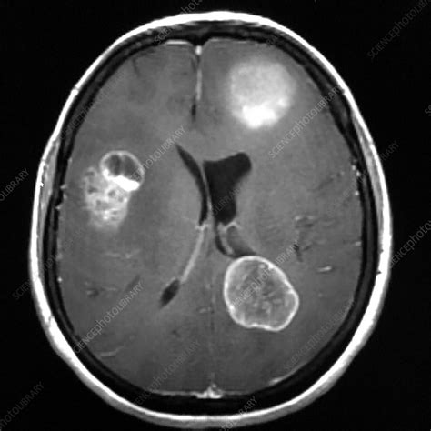 Metastatic Disease to Brain, MRI - Stock Image - C039/4243 - Science ...