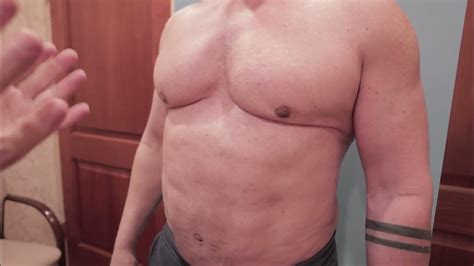 Gynecomastia Surgery 7month Post Op Connecticut Male Vaser Lipo Neck 2 Nuts Renuvion Gland