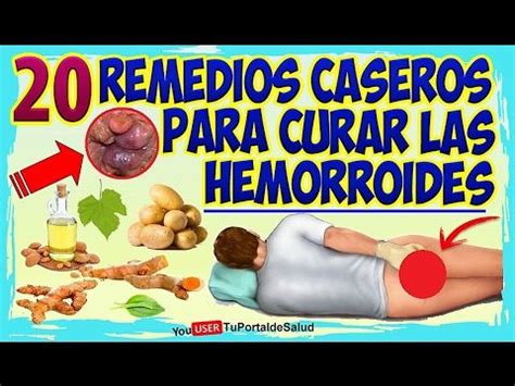 Como Curar Las Hemorroides Con 20 Remedios Caseros Hemorroides Internas