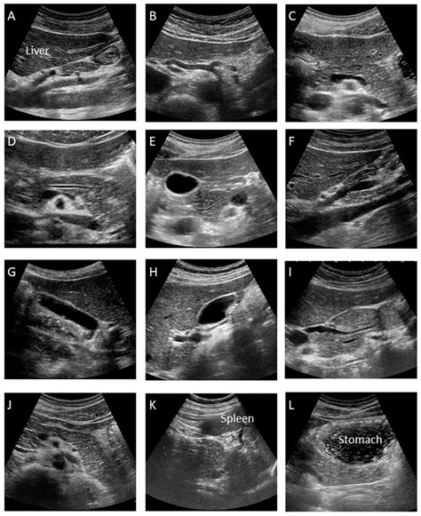 Pancreatic Adenocarcinoma Ultrasound