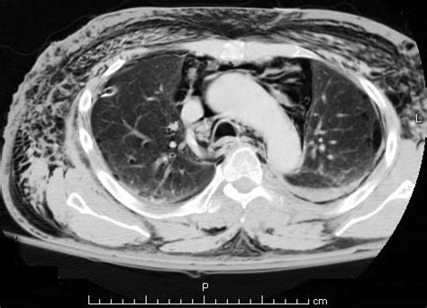 MedicoNotebook: Hamman's syndrome and sign