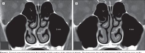 Pdf Effect Of Septoplasty On Inferior Turbinate Hypertrophy