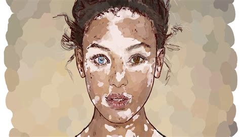 Vitiligo Nedir Belirtileri Ve Beslenme Tedavisi Nas Ld R