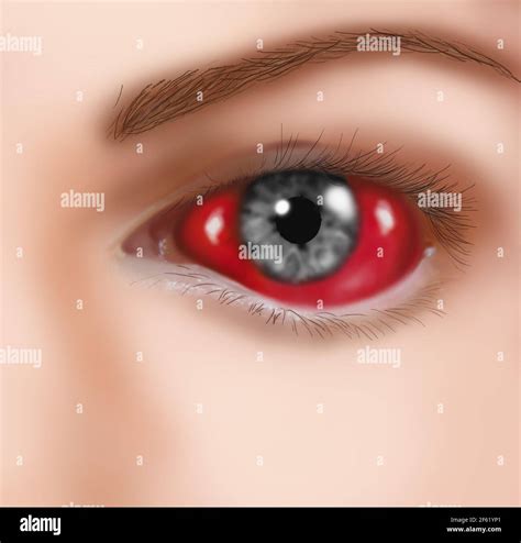 Eye Hemorrhage Hi Res Stock Photography And Images Alamy