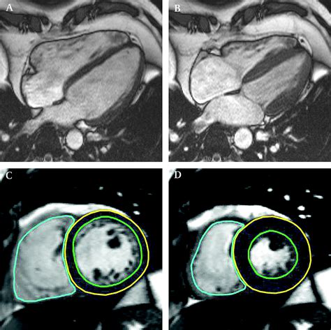 Cardiovascular Magnetic Resonance Imaging In Patients With Acute