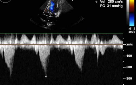 Lvot Gradient In Hocm Doppler Echocardiogram All About