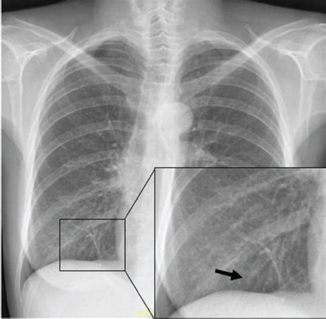 Chest X Ray Pneumonia Vs Bronchitis