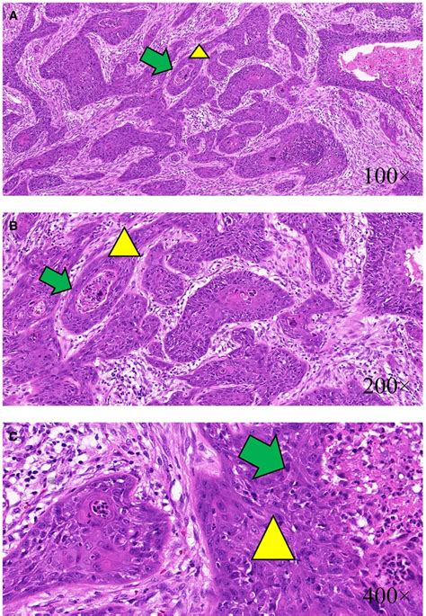 Frontiers Breast Implant Associated Squamous Cell Carcinoma In A Male