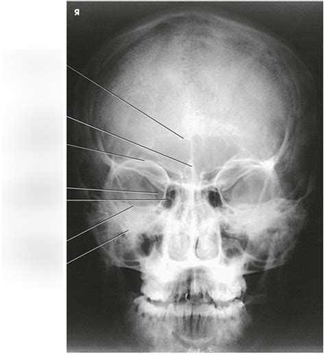 Inferior Orbital Fissure Radiology