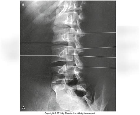 Oblique Lumbar Spine Diagram Quizlet