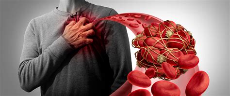 Why Blood Clot Prevention Matters - HoneyColony