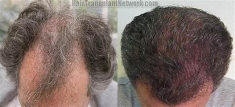 Dr Timothy Carman Hair Transplant Before And After Photos From 3099