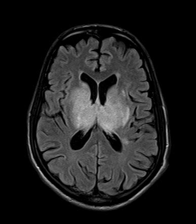 Viewing Playlist Stroke Cases Radiopaedia Org