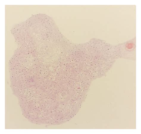 (a) Cervical biopsy. Initial section showing strips of ectocervical... | Download Scientific Diagram